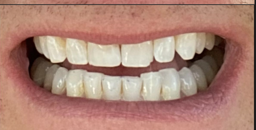 Repaired front tooth after dental bonding by Dr. Kaur