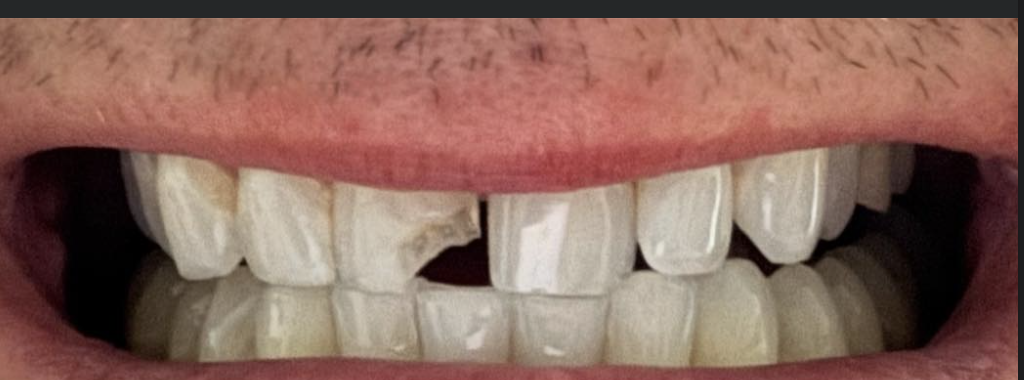 Cracked front tooth before dental bonding