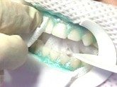 A protective coating placed on gums during Zoom Whitening