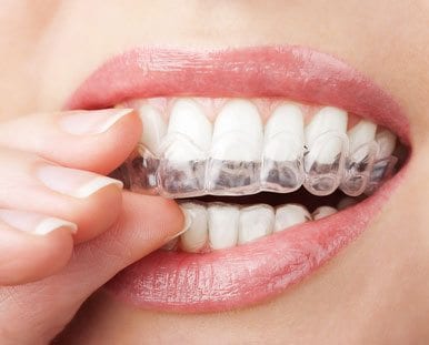 teeth whitening tray being placed on teeth