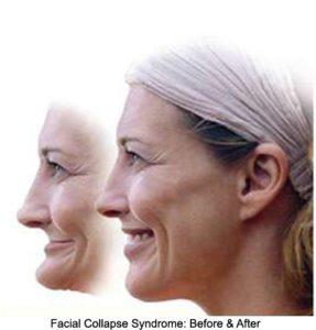A Woman shown before and after facial collapse