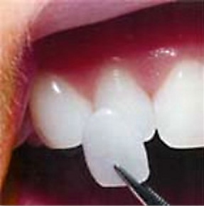 Porcelain veneer being held up to a natural tooth
