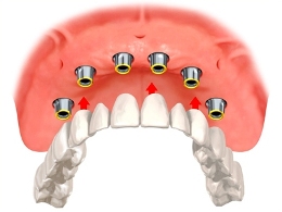 Implant overdentures